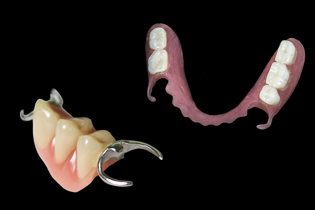 部分入れ歯|鹿沼台こばやかわ歯科