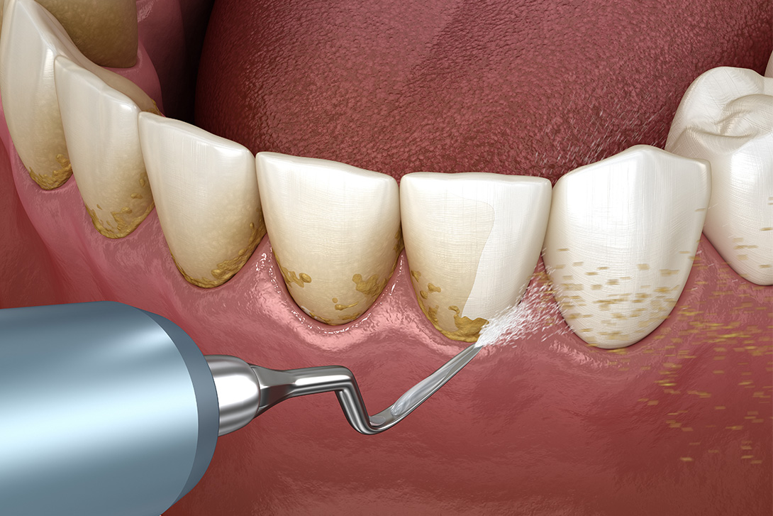歯石除去｜鹿沼台こばやかわ歯科