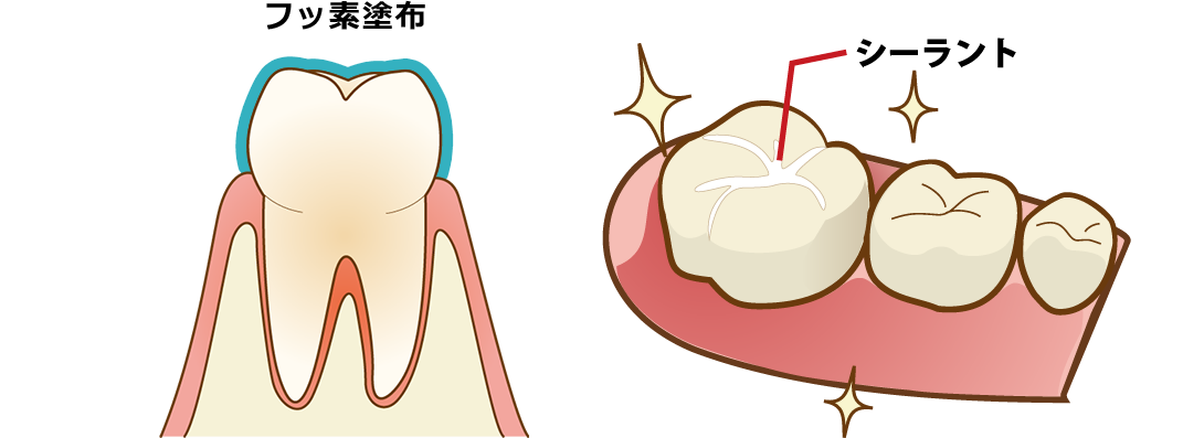 フッ素塗布やシーラントで虫歯を防ぐ