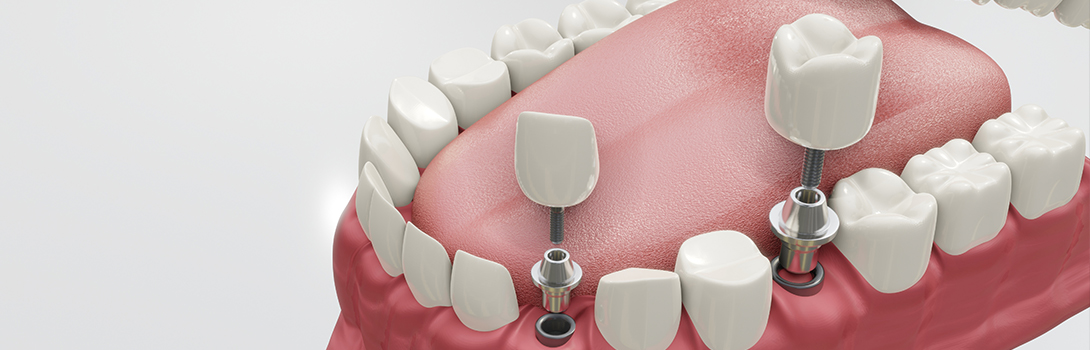 インプラント｜鹿沼台こばやかわ歯科