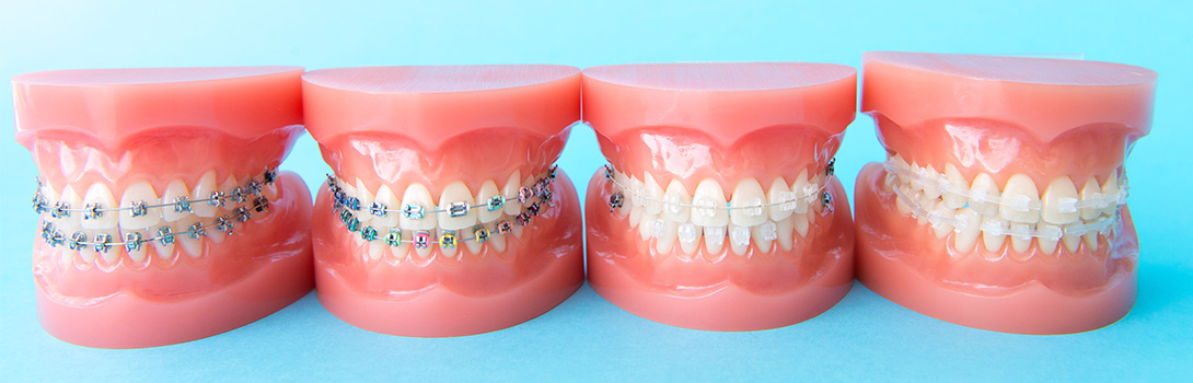 矯正歯科｜鹿沼台こばやかわ歯科