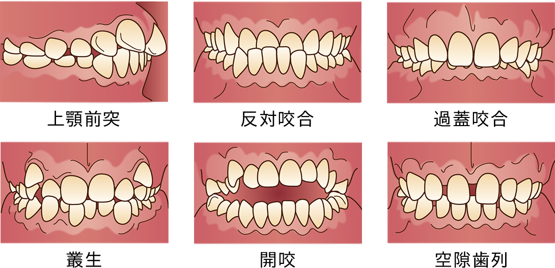 矯正が必要な歯並びの例｜鹿沼台こばやかわ歯科