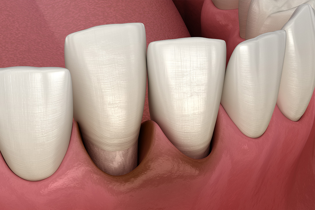 歯周病が進行し歯が長くみえてしまう現象が起こることも｜鹿沼台こばやかわ歯科