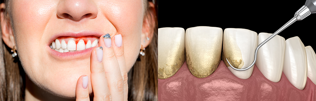 歯周病治療｜鹿沼台こばやかわ歯科