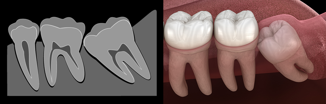 親知らずの抜歯｜鹿沼台こばやかわ歯科
