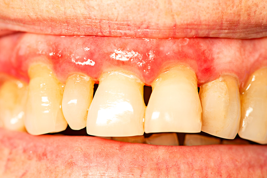 歯垢と歯石の違いとは？｜鹿沼台こばやかわ歯科