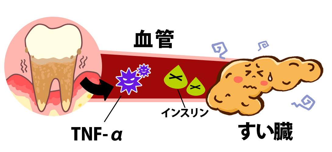 歯周病とすい臓｜淵野辺の歯医者　こばやかわ歯科